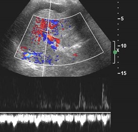 Doppler hep v
