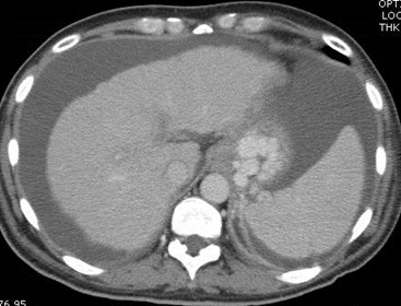 Ct gastric varices