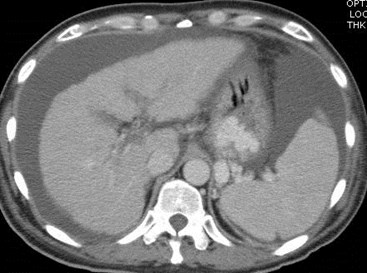CT 1