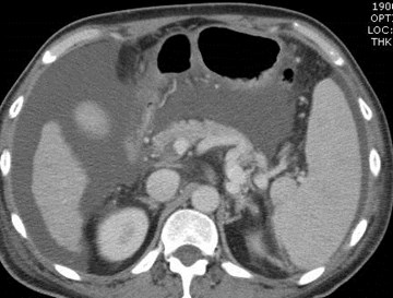 Ct clot begins at portal confluence