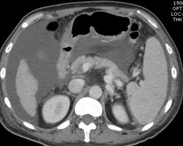 spenorenal varices