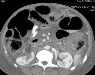 CT mesenteric varices 2