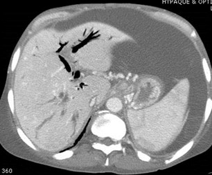 CT gastric, coronary varices
