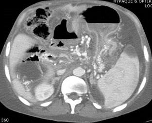 CT mesenteric varices