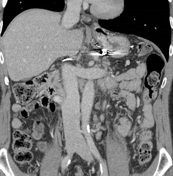 caval end of shunt