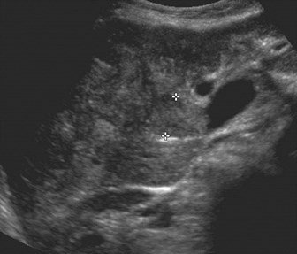 PV thrombus