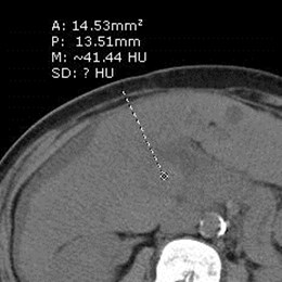 non con PV thrombus HU
