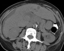 non con PV thrombus