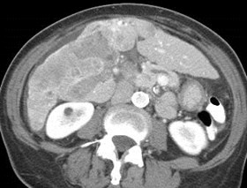 branching PV w thrombus
