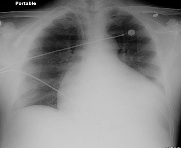 CXR