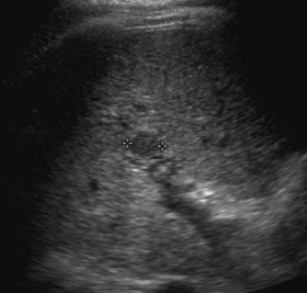 pseudo lesion, actual PVT
