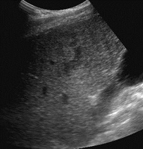 peripheral tumor