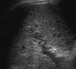 pseudo lesion, actual PVT