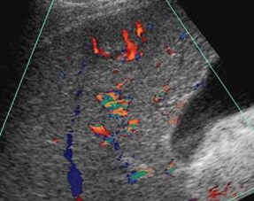 vascularity of tumor