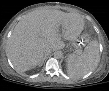 CT 1