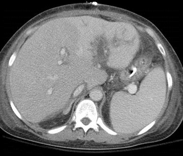 CT 1
