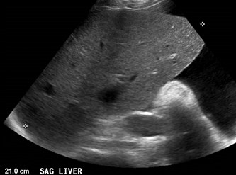 hepatomegaly and ascites