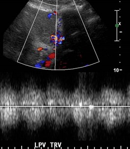 L PV doppler