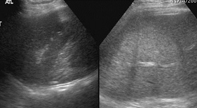 liver, spleen