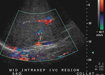 compressed IVC trv