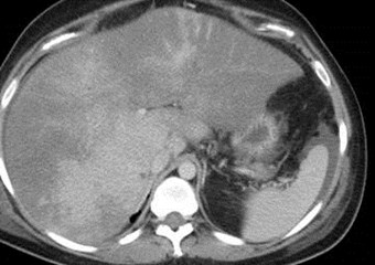 CT PV 2 caudate lobe enhancem