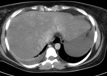 CT PV 1