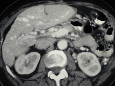 Mitchell, A-4 big arts near kidney
