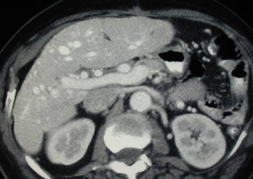 Mitchell, A-3 big hep a