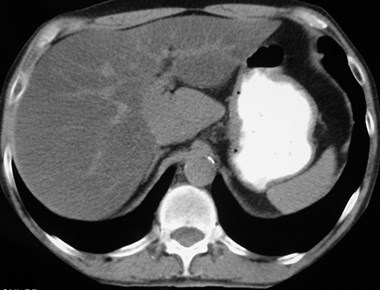 20-02b Focal fatty infiltration