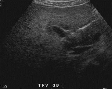 trv Gb-1