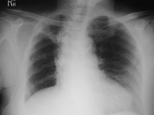 chest tube outside ribs.jpg                                    00031510Macintosh HD                   BA578DA3: