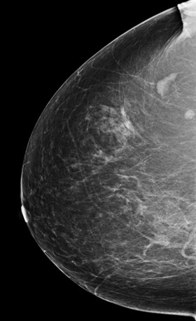 lymph node wu exag cc.jpg