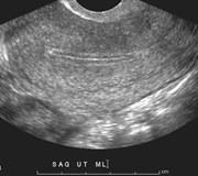 6-8 pre-ov endometrium.jpg