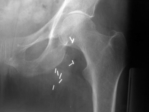 occult fracture xray