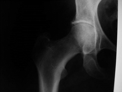 RA xray