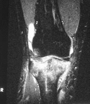 bone bruise