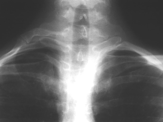 cervical rib with pseudoarticulation