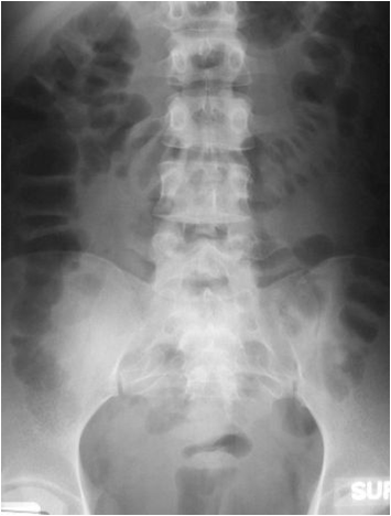 Normal-Pcture frame of bowel