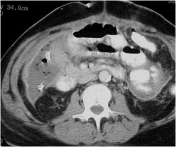 RLQ abscess-abdomen-CT