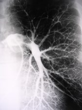 pulmonary embolus on angio