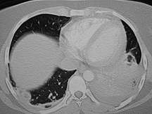 CT lung 1