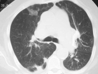 pulm infarct Compton mosiac 3