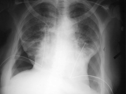 G:\photos\pleura\pneumothorax\trapped lung 1.jpg