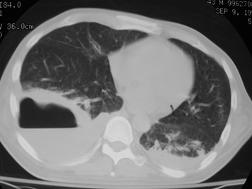 empyema bey CT lung 2 