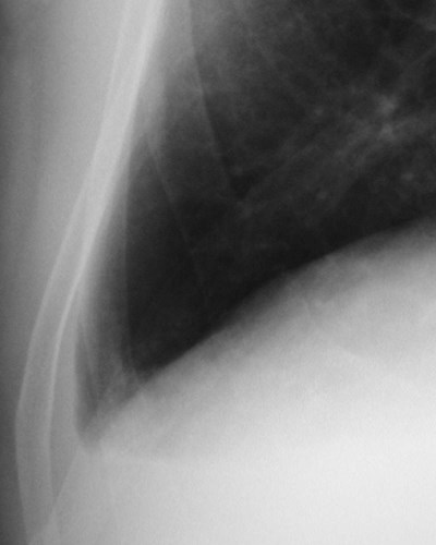 laminar effusion