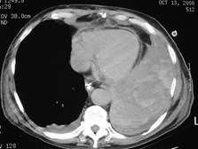 pleural hematoma CT 3 