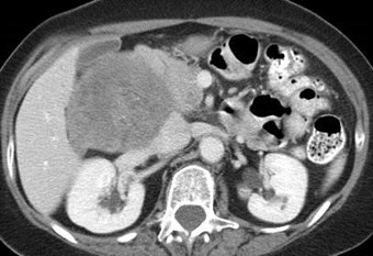 CT 2 at renal veins