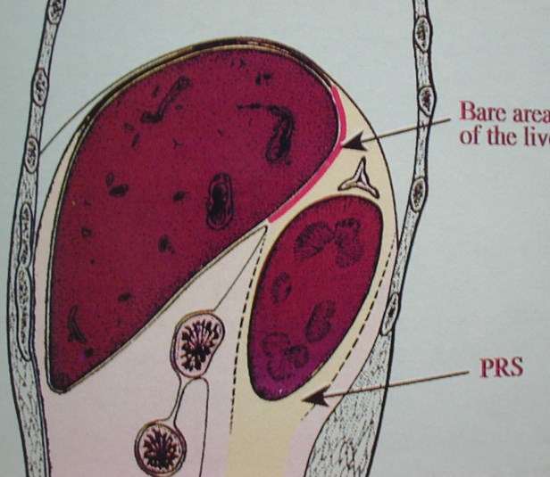 Color Diagram-Sag-Perinephic-Bare Area Liver