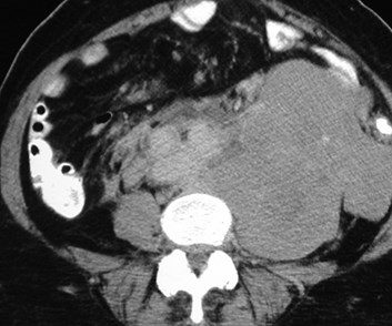 Armstrong-massive lymphome CT below kidneys