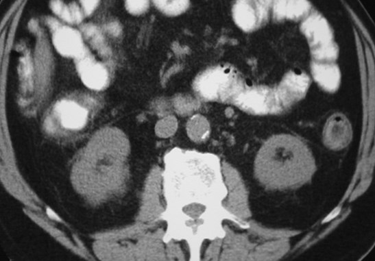 CRF-subcapsular lines, Gerota's fascia-CT2